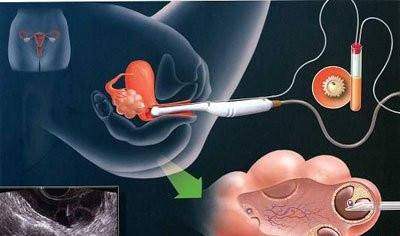 体外受精 IVF-ET